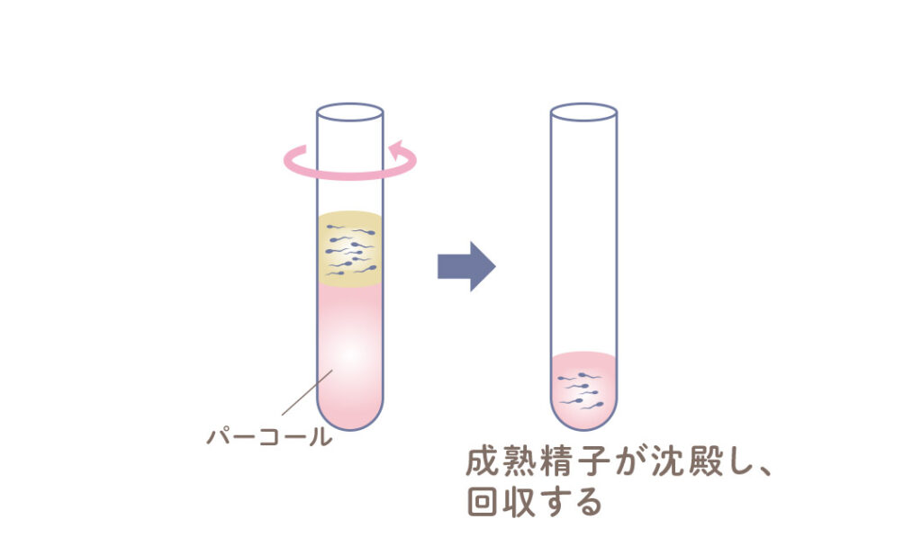 パーコール法