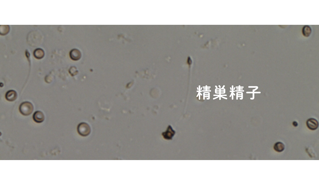 TESE-ICSIの実際